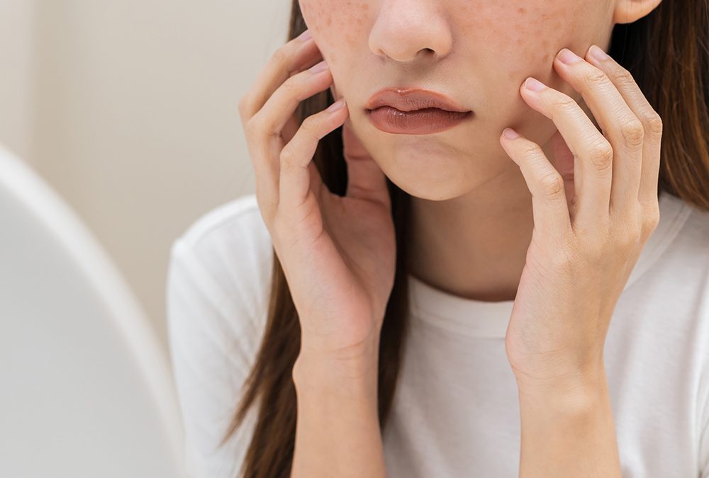 Unveiling GlocalCare: Your Post-Laser Hyperpigmentation Rescue Plan
