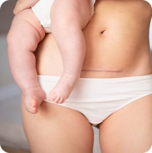 C Section Scar