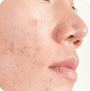 Acne Scars