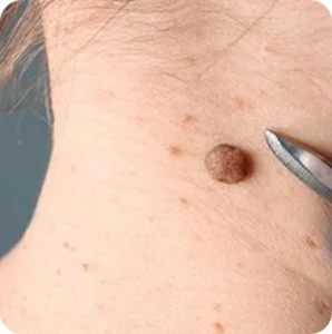 Mole Removal Scars