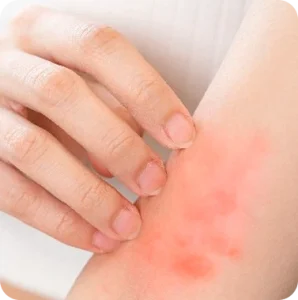 Skin Irritation