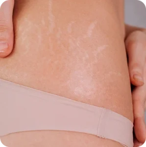Stretch Marks