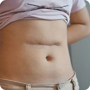 Surgical Scar