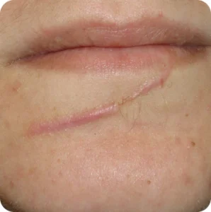 Trauma Scars