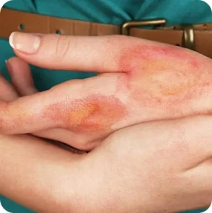 Burns Scars