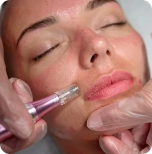 Post-Rejuvenation Scars